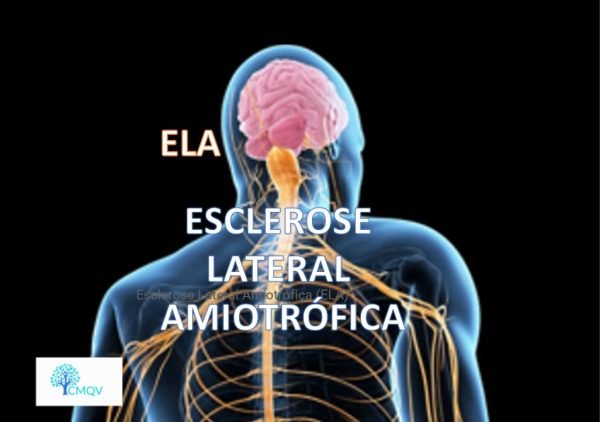 Esclerose Lateral Amiotrófica ELA Consulte vida